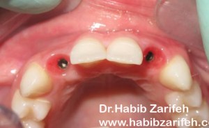 dentalimplantsbeirut