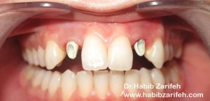 Dentalimplantslebanon