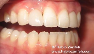 dentalimplantslebanonbeirut