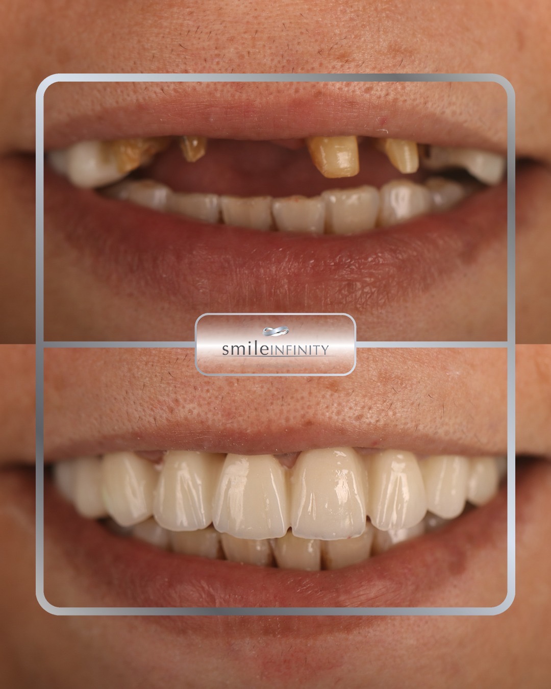 One Day Implant&reg; patient result &mdash; permanent same-day tooth replacement by Dr. Habib Zarifeh, Beirut Lebanon
