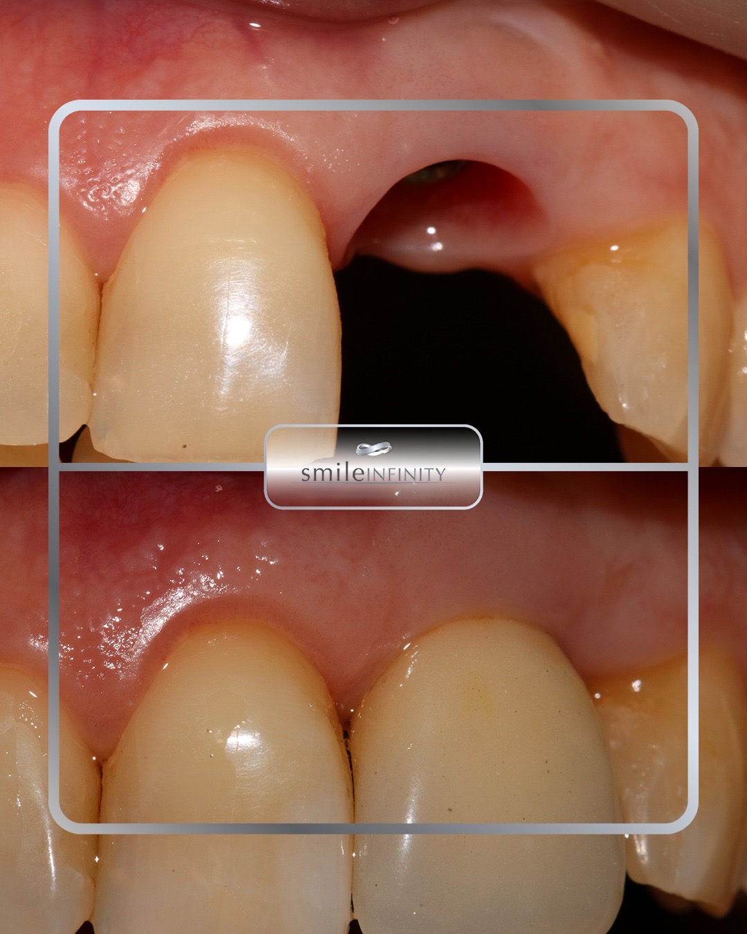 One Day Implant&reg; result by Dr. Habib Zarifeh &mdash; same-day dental implant, CMC Hospital Beirut, Lebanon