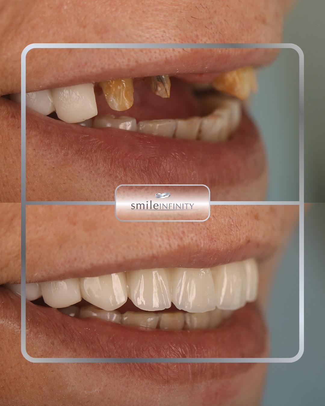 One Day Implant&reg; case &mdash; titanium implant and zirconia crown placed in a single session by Dr. Habib Zarifeh, Beirut